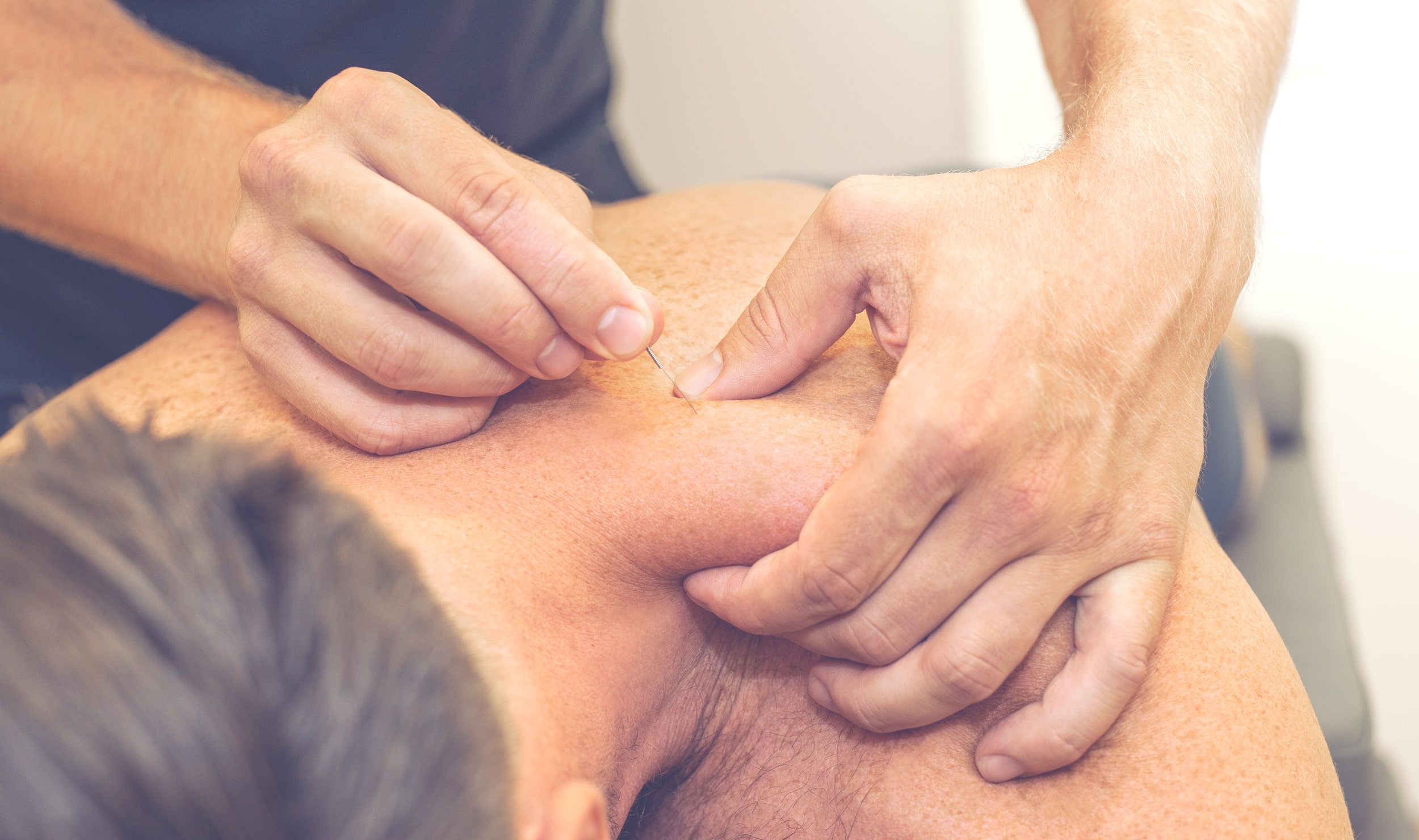 dry needling